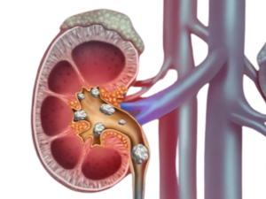 Renal Stone Treatment in Bathinda