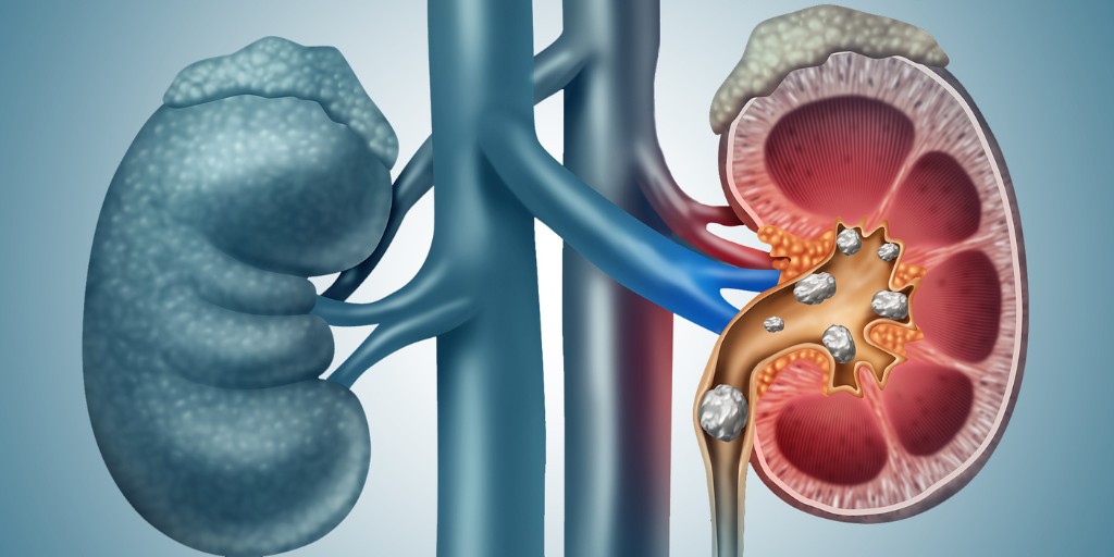 renal stone in bathinda