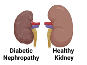 diabetic kidney disease treatment in bathinda